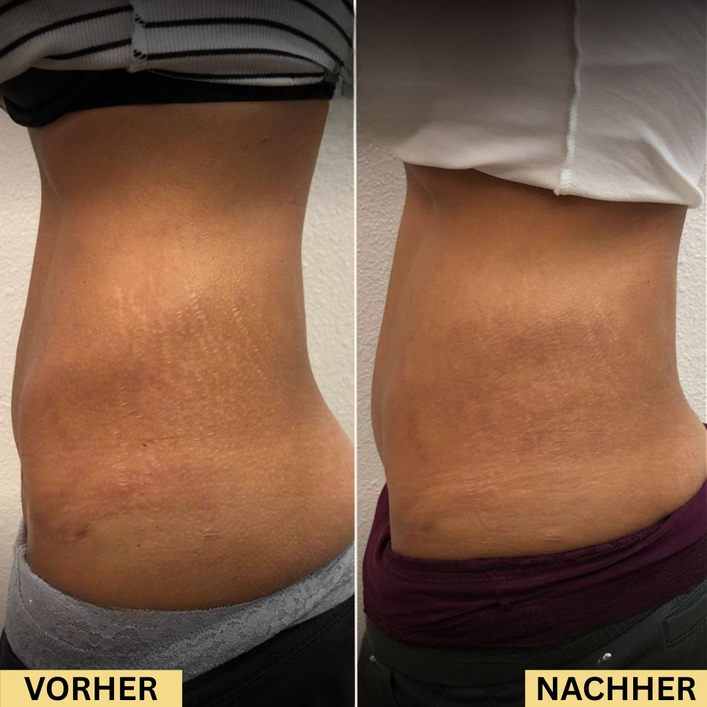 Serava® | Anti-Dehnungsstreifen Serum