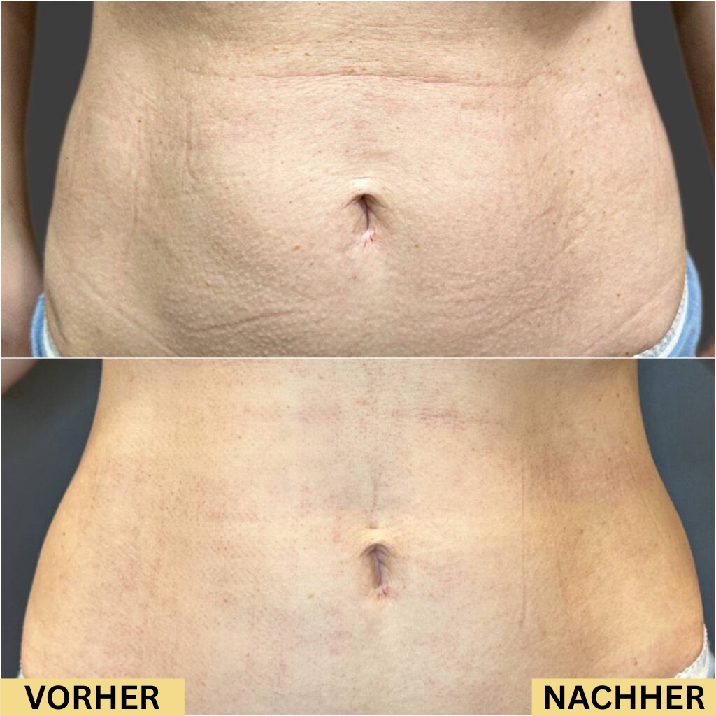 Serava® | Anti-Dehnungsstreifen Serum