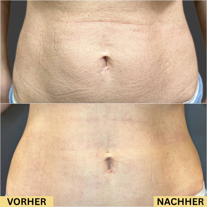 Serava® | Anti-Dehnungsstreifen Serum