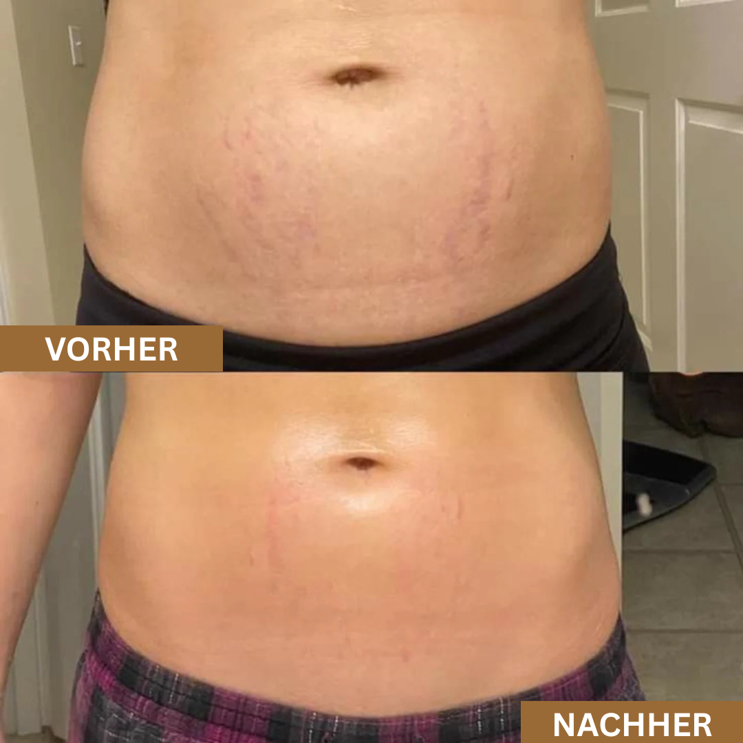 Serava® | Anti-Dehnungsstreifen Serum