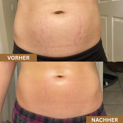 Serava® | Anti-Dehnungsstreifen Serum