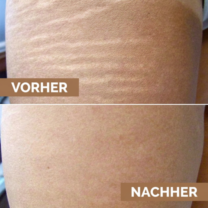 Anti-Dehnungsstreifen Serum