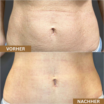 Anti-Dehnungsstreifen Serum